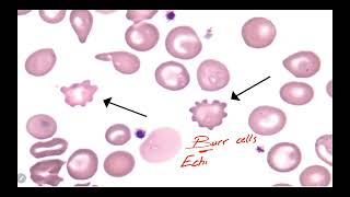 IM Hematology 3 Anemia Microcytic Anemia of chronic disease ACD [upl. by Bartholomeo]