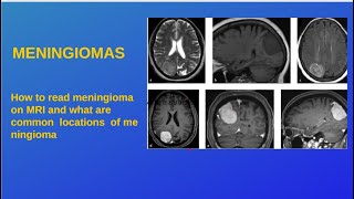 Case Cerebellopontine angle Meningioma [upl. by Ford]