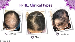 IDENTIFYING ANDROGENETIC ALOPECIA WHERE DOES GENETIC HAIR LOSS OCCUR [upl. by Nyltak]