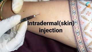 intradermal or skin injection [upl. by Anelehs]