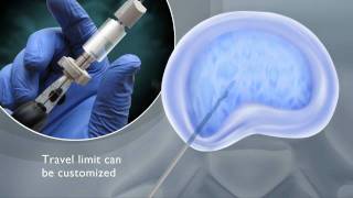 enSpire Interventional Discectomy System [upl. by Briant]