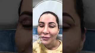 LiKE amp SUBSCRIBE ✅ Operație Blefaroplastie Liftingul pleoapelor superioare [upl. by Honora]