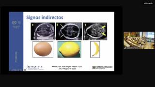 Diagnostico prenatal de Mielomeningocele [upl. by Pelletier677]