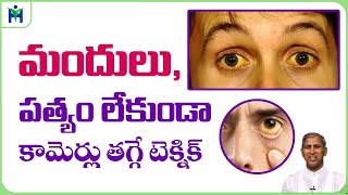 కామెర్లు మందులు లేకుండా తగ్గించుకోవటం ఎలాManthena Satyanarayana Raju Health Mantra [upl. by Bel]