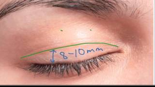 Marking the Upper Eyelid Incision [upl. by Terriss297]