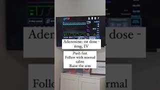 Supraventricular Tachycardia  ECG interpretation [upl. by Asirram]