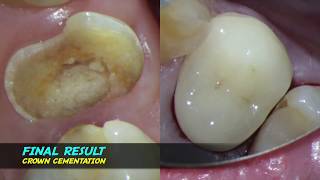 single visit root canal therapy endodontic one curve micromega warm vertical compaction [upl. by Grimona]