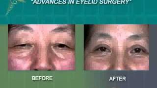 Eyelid Surgery Interview with Before and After Pictures Part 2 [upl. by Alleram]