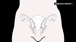 What are uterus transplants [upl. by Dnomde]