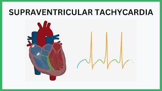 Supraventricular Tachycardia SVT Visualised [upl. by Fanestil]