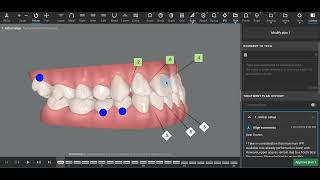 Class III Invisalign [upl. by Nogras]