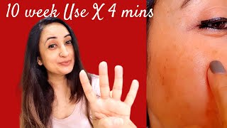 Be Minimalist Tranexamic AcidSerum 10 WEEK Live Result Mini Product Review 4Min Review [upl. by Nonnac]