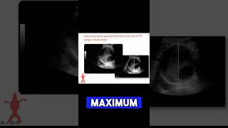 Abdominal artery aneurism ultrasound  foryou vascularintervention ABCVascularUltrasound [upl. by Lekim967]