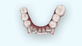 Cerec Ortho and Invisalign [upl. by Inotna]