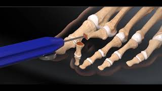 Hammertoe Shortening Surgery [upl. by Ferne]