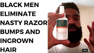 5 Ways Black Men ELIMINATE NASTY Ingrown Hairs and Razor Bumps [upl. by Bilak505]