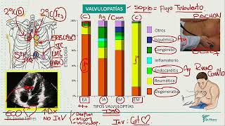 Valvulopatias Estenosis Aortica Insuf Aortica Estenosis Mitral Insuficiencia [upl. by Faulkner]