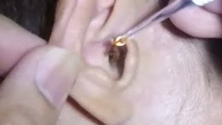 Nasty Earwax Removal in Man [upl. by Mcloughlin53]