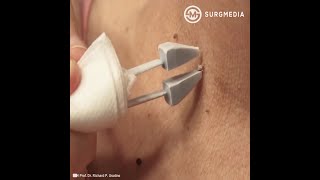 How Does Cryosurgery Cryotherapy  Cryoablation Works medical video shorts [upl. by Wan279]