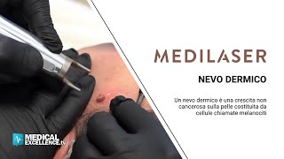 Vaporizzazione di un nevo dermico con laser CO2 efficace e indolore [upl. by Suiratnauq]