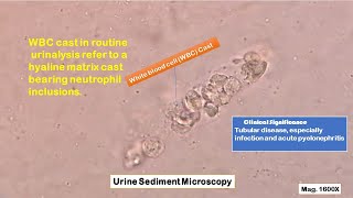 WBC casts in Urine Sediment Microscopy Introduction Identification and Clinical Significance [upl. by Alla809]