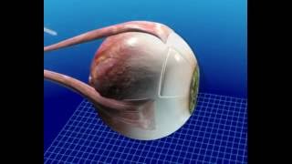 Molteno3 Glaucoma implant insertion animation [upl. by Ahmed]