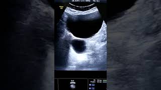 Adnexal hemorrhagic cyst videos ultrasound viral viral video [upl. by Grimbald]