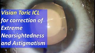 Visian Toric EVO ICL surgery for correction of extreme nearsightedness myopia and astigmatism [upl. by Ahcsap191]