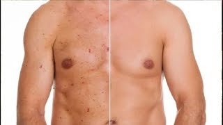 how to get rid of chest acne and back acne [upl. by Dranrev]