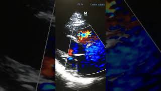 Estenosis Valvular Aòrtica po Ecocardiografia Doppler color Plano Para sete al [upl. by Ellak940]