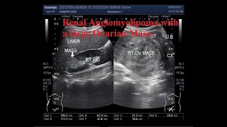 Renal Angiomyolipoma with a large Ovarian Mass [upl. by Acirt]