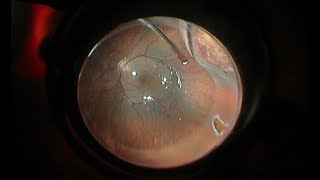 Retinal detachment vitrectomy Tips  Consejos en vitrectomía para DR [upl. by Evetta717]