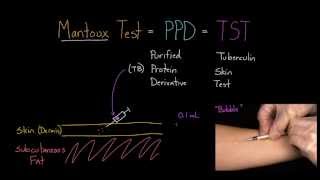 Mantoux Test aka PPD or TST [upl. by Hoyt]