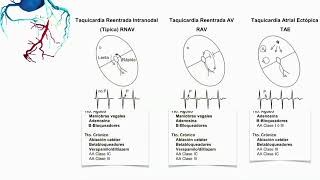 Tratamiento de las Taquicardias Supraventriculares [upl. by Nollat]