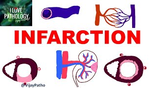 INFARCTION Causes Types Morphology [upl. by Rae]