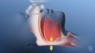 Obesity Hypoventilation Syndrome  Mayo Clinic [upl. by Enrak]