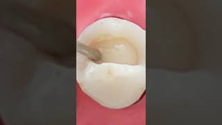 Dental Composite Fillings  Unboxing 3M ESPE Filtek Z350 XT Composite  shorts [upl. by Grega140]