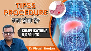 TIPSS Procedure क्या होता है  TIPS Complications and Results  Dr Piyush Ranjan [upl. by Tengdin]