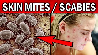 8 Effective Remedies To Get Rid of Skin MitesScabies Naturally [upl. by Mulloy542]