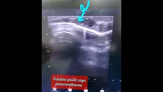 Neonatal Lung Ultrasound  Identifying the Double Point Sign in Pneumothorax pocus neonates [upl. by Deming]