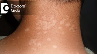 Pharmacological management of Tinea Versicolor in young individuals  Dr Urmila Nischal [upl. by Nosemaj]