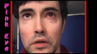 Severe Bacterial Pink Eye Conjunctivitis treatment part 2 [upl. by Arlana]