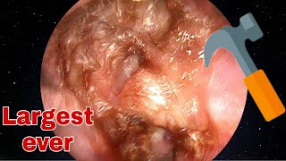 LARGEST Ear Wax Removal 20 years ear surgery  Doctor Anh [upl. by Nilson]