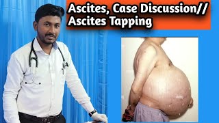 Ascites  Case Discussion Ascites Tapping Procedure [upl. by Ecirbaf620]