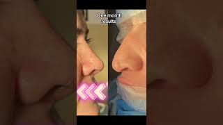 rhinoplastysociety cosmeticsurgery rhinoplastybeforeandafter doctor plasticsurgery rhinoplasty [upl. by Young]