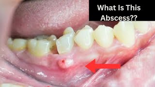 What is an Abscessed Tooth and What To Do About It [upl. by Alin]