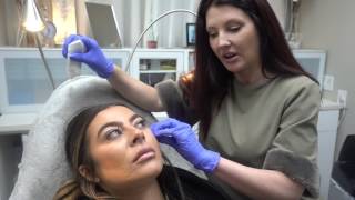 Lateral Cheekbone Augmentation using 15ml of Radiesse [upl. by Caiaphas980]