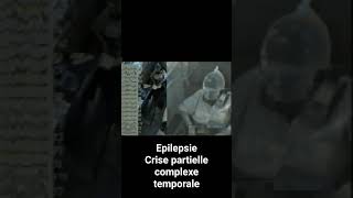 Epilepsie  crise partielle Complexe temporale [upl. by Onra]