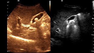 Cholelithiasis  Cholesterol specks  Grade 3 Fatty Liver  Cholesterolosis [upl. by Shanney]