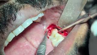 Surgical removal of impacted mandibular molar [upl. by Ynar]